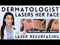 What it’s Like to Have Laser Resurfacing: Procedure, Care & Results | Dermatologist Tests