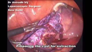 laparoscopic paraovarian cyst excision