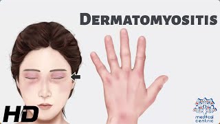 Dermatomyositis: Everything You Need To Know