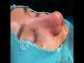 kalın derili burun estetiği rhinoplasty turkey op. dr. mithat topal mall of İstanbul