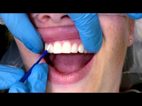 How long do we apply topical fluoride?