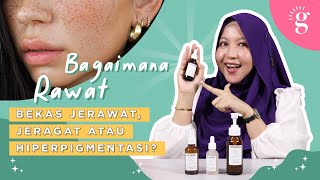 Bekas Jerawat? Jeragat? Apakah Cara Untuk Hilangkan? | Review Hollaface