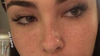 ღ your nose bridge is so narrow! ~ nasal bone reduction procedure 💉