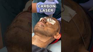 Carbon laser treatment | Laser face treatment | Carbon Laser | Glowing skin laser