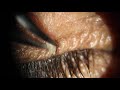 Eyelid Skin Tag Removal Viral Papilloma