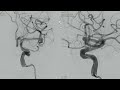 left mca bifurcation aneurysm treated by endovascular intrasaccular flow diversion.