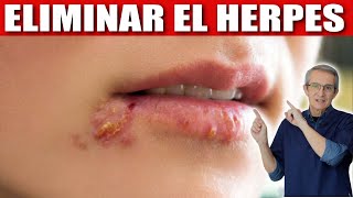 Cómo ELIMINAR el HERPES