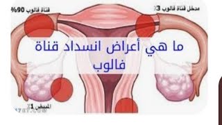 لو ظهرت عليك العلامات عندك انسداد في قنوات فالوب أو التصاقات هتكون سبب تأخر الحمل