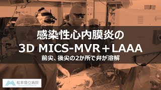 感染性心内膜炎の3D MICS-MVR＋LAAA