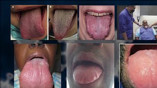 Some COVID-19 patients reporting new symptom affecting their tongue