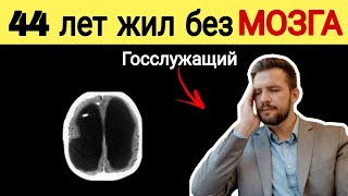 Этот Мужчина жил 44 лет Без Мозга 🧠  Матье Француз  #матье #французбезмозга