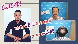 大面積植髮效果公開展示，植髮術後效果恢復驚呆眾人！Yonghe hair transplant