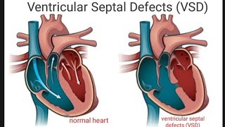 Ventricular Septal Defects (VSD)- (Types, Clinical manifestations, Diagnostic evaluation, Treatment)