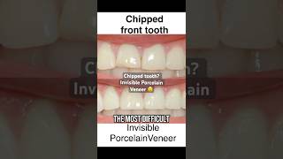 Chipped tooth ? Invisible Porcelain Veneer😲 Can you tell ?