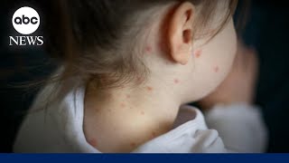 Measles death in US ‘a preventable tragedy’: Doctor