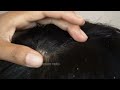 extreme dandruff removal big flakes asmr 742