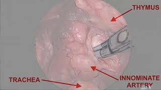 Asvide: The procedure of transcervical thymectomy