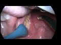 coblation total intracapsular tonsillectomy tonsillotomy case 1