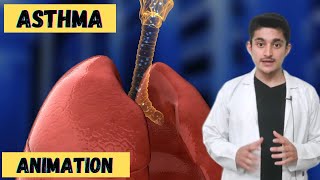 Asthma attack 3d animation in hindi | causes symptoms treatment | breath problem | pathophysiology