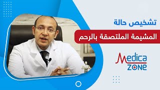 تشخيص حالة المشيمة الملتصقة بالرحم مع دكتور حسن جعفر | MedicaZone