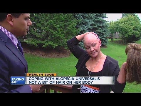 Woman living with Alopecia Universalis Woman living with Alopecia Universalis