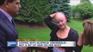 Woman living with Alopecia Universalis