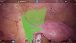 VirtaMed LaparoS™ - Endometriosis I
