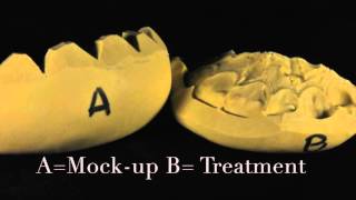 Diastema closure