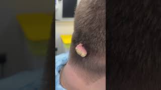 MASSIVE cauliflower wart removal at Dr.Medispa 😱