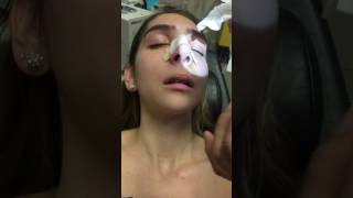 Removing a Nasal Stent 5 Days after Rhinoplasty