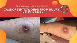 Homeopathic Treatment \u0026 Medicines for Septic wound from Injury|Dr.Ravi kumar M.D|KALYAN HOMOEO CARE