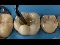 ribbond composite restorations