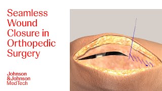 Effective Wound Closure Techniques in Orthopedic Surgeries Using DERMABOND | J\u0026J MedTech