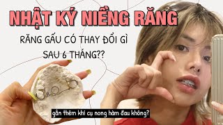 NHẬT KÝ NIỀNG RĂNG | Mình Phải Gắn Khí Cụ Nong Hàm Sau 6 Tháng 😰