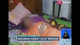 Miris!! Siswi SMK Alami Kulit Bersisik Hingga Kondisi Terus Melemah - BIS 17/10