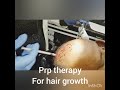 Platelet rich plasma therapy for hair growth