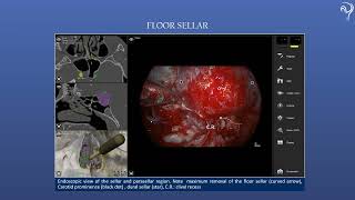 INTRAOPERATIVE SURGICAL INTEGRATION IN REAL TIME TO THE NEURONAVIGATION IN PITUITARY MACROADENOMA