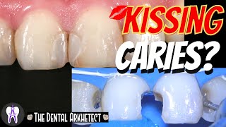 INCREDIBLE Kissing Restoration for Kissing Caries #C37 #4K