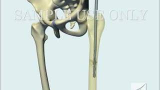 Femoral Fracture Fixation Surgery: Intramedullary Nail