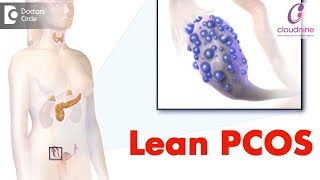 What is lean PCOS? -  Dr. Bandita Sinha of Cloudnine Hospitals | Doctors' Circle