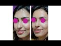 a natural result in rhinoplasty dr. aniketh venkataram the venkat center bengaluru