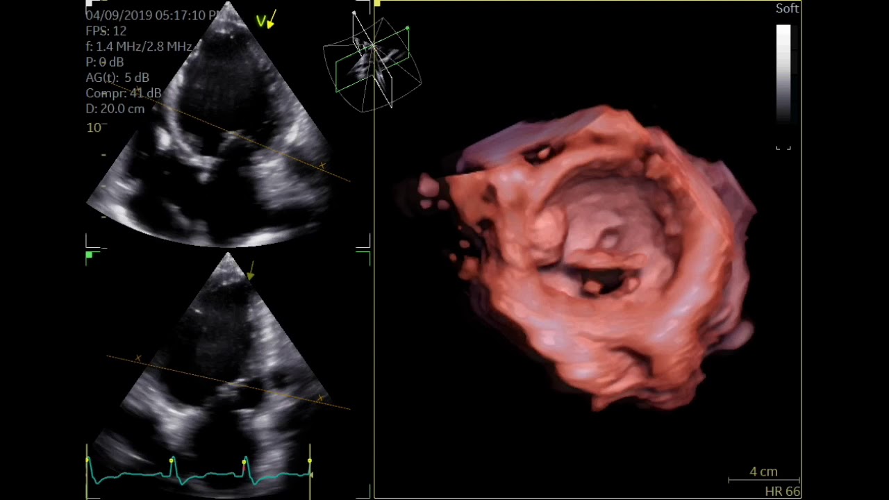 Severe Lv Dysfunction Youtube