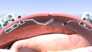 Intra-abdominal Surgical Robot