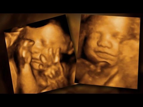 How much is a 3D sonogram in NY?