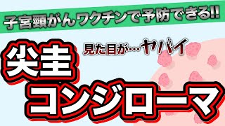 【尖圭コンジローマ】子宮頸がんワクチンで防げる！産婦人科医上村茂仁が正しい性感染症の知識をわかりやすく解説！