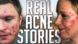 Emotional Struggle of Acne | REAL PEOPLE'S STORIES
