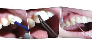 Effective tooth desensitisation with Profluorid Varnish - versatile in taste and application form