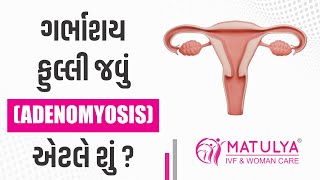 ગર્ભાશય ફુલ્લી જવું એટલે શું ? | Adenomyosis | Dr.Hitesh Italiya | Matulya IVF \u0026 Woman care | Surat