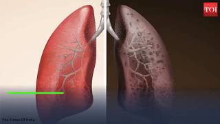 A 28-year-old non-smoking woman with stage four lung cancer. Dr. Arvind Kumar ( Medanta, Gurgaon)