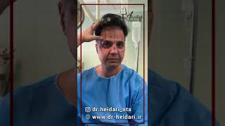 Endoscopic forehead lift and facial fat injection | لیفت اندوسکوپی پیشانی و تزریق چربی به صورت